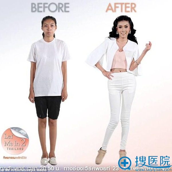 泰国龅牙妹Punbu术前术后对比效果 泰国龅牙妹Punbu术前术后对比效果