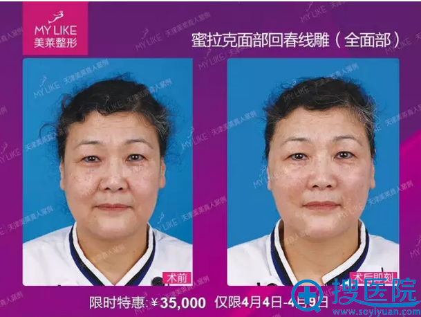 天津美莱全面部线雕前后对比图 天津美莱全面部线雕前后对比图