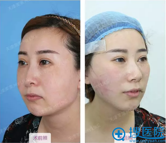面部线雕术后45°角效果 面部线雕术后45°角效果