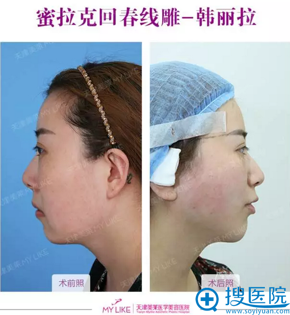 面部线雕术后侧面效果 面部线雕术后侧面效果