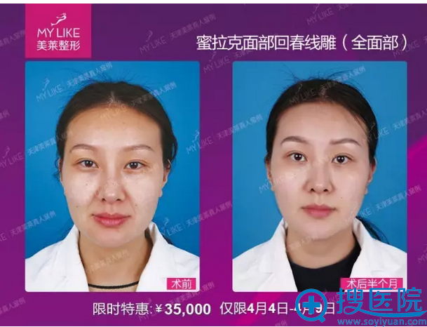 天津美莱面部线雕真人案例 天津美莱面部线雕真人案例