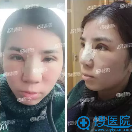 做隆鼻和双眼皮3天了 做隆鼻和双眼皮3天了