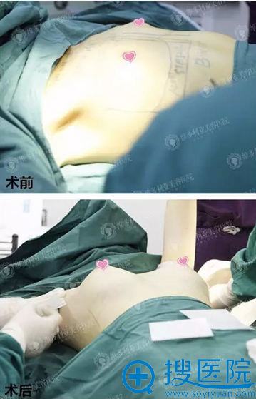 术前术后即刻效果对比 术前术后即刻效果对比