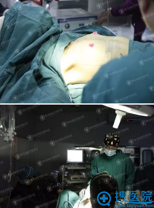 隆胸手术进行中 隆胸手术进行中