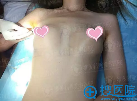 隆胸7天拆线 隆胸7天拆线