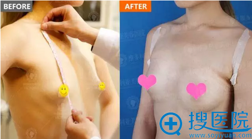 隆胸术前术后对比 隆胸术前术后对比
