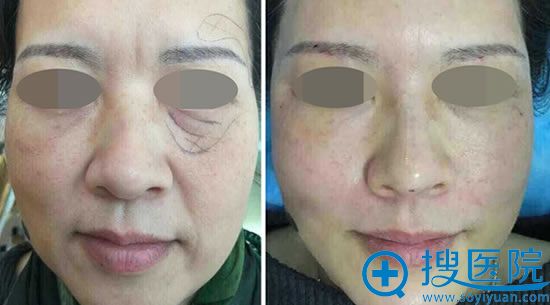 50岁阿姨面部线雕前后效果对比 50岁阿姨面部线雕前后效果对比