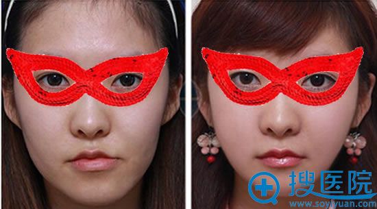 自体脂肪填充面部前后效果对比照片 自体脂肪填充面部前后效果对比照片