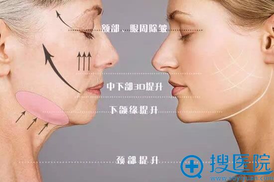 面部线雕效果示意图 面部线雕效果示意图