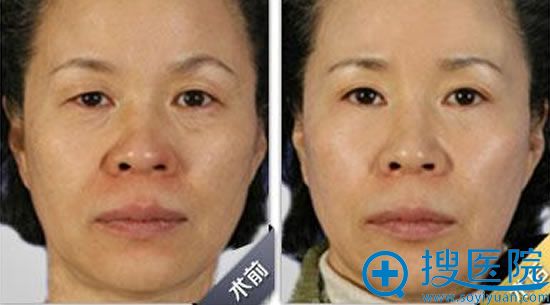 45岁面部激光除皱案例效果图 45岁面部激光除皱案例效果图