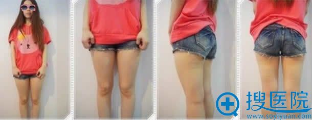 上海九院自体脂肪丰胸手术前照片 上海九院自体脂肪丰胸手术前照片