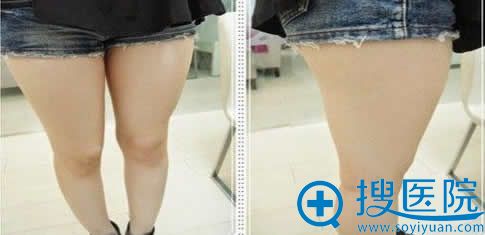 在九院做大腿吸脂前的照片 在九院做大腿吸脂前的照片