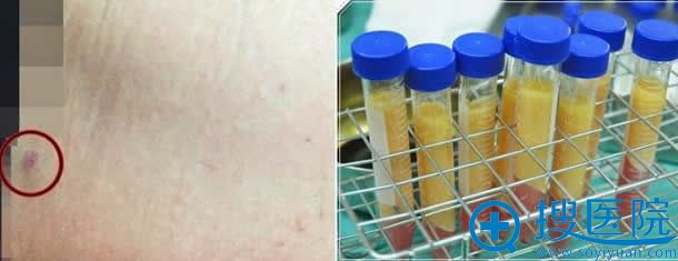 上海九院大腿吸脂手术过程图 上海九院大腿吸脂手术过程图