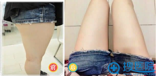 九院整形科大腿吸脂前后效果对比 九院整形科大腿吸脂前后效果对比