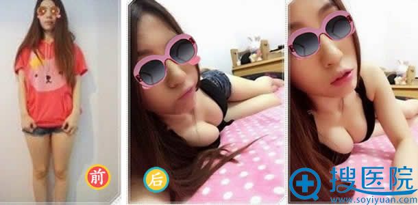 在上海九院做自体脂肪隆胸对比照 在上海九院做自体脂肪隆胸对比照