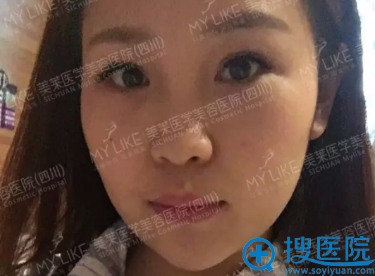 术前塌鼻子 术前塌鼻子