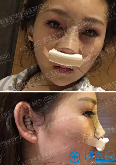 隆鼻术后天效果 隆鼻术后天效果