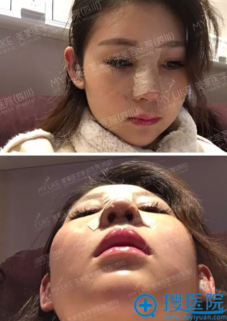 隆鼻术后第三天细节图 隆鼻术后第三天细节图