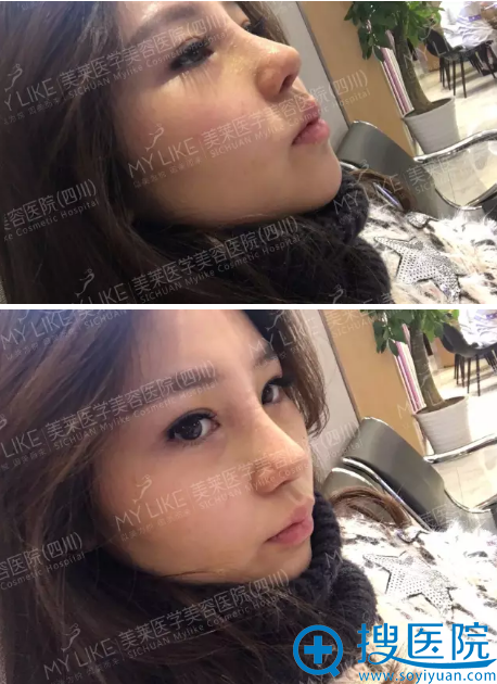 隆鼻术后7天恢复效果 隆鼻术后7天恢复效果