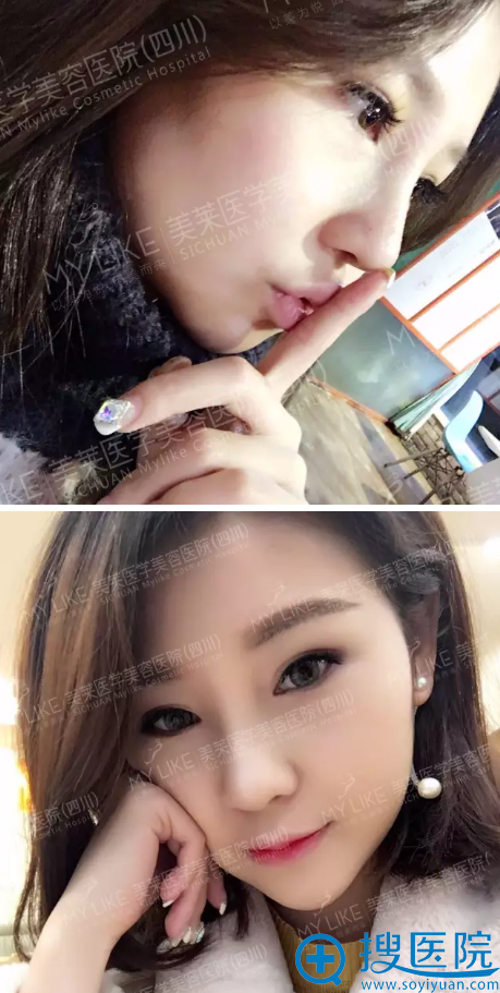 隆鼻术后半个月恢复期效果 隆鼻术后半个月恢复期效果