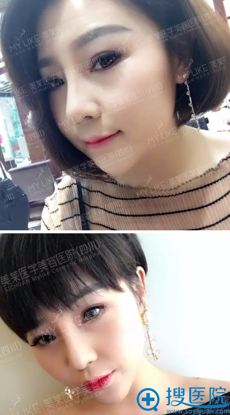 隆鼻术后一个月生活照 隆鼻术后一个月生活照