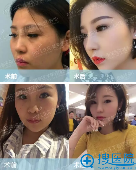 在成都美莱做隆鼻前后对比图 在成都美莱做隆鼻前后对比图