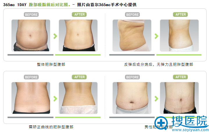 韩国首尔365mc医院腹部吸脂前后对比案例 韩国首尔365mc医院腹部吸脂前后对比案例