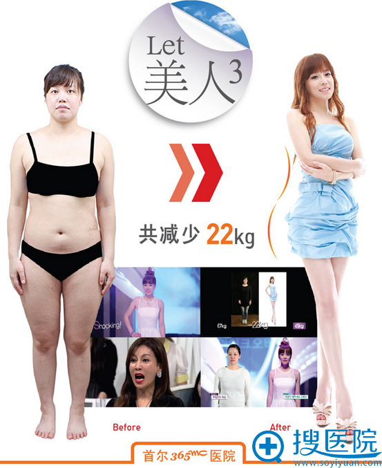 韩国首尔365mc医院LET美人3吸脂真人案例 韩国首尔365mc医院LET美人3吸脂真人案例