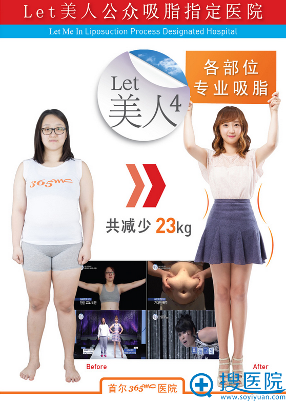 韩国首尔365mc医院LET美人4吸脂真人案例 韩国首尔365mc医院LET美人4吸脂真人案例