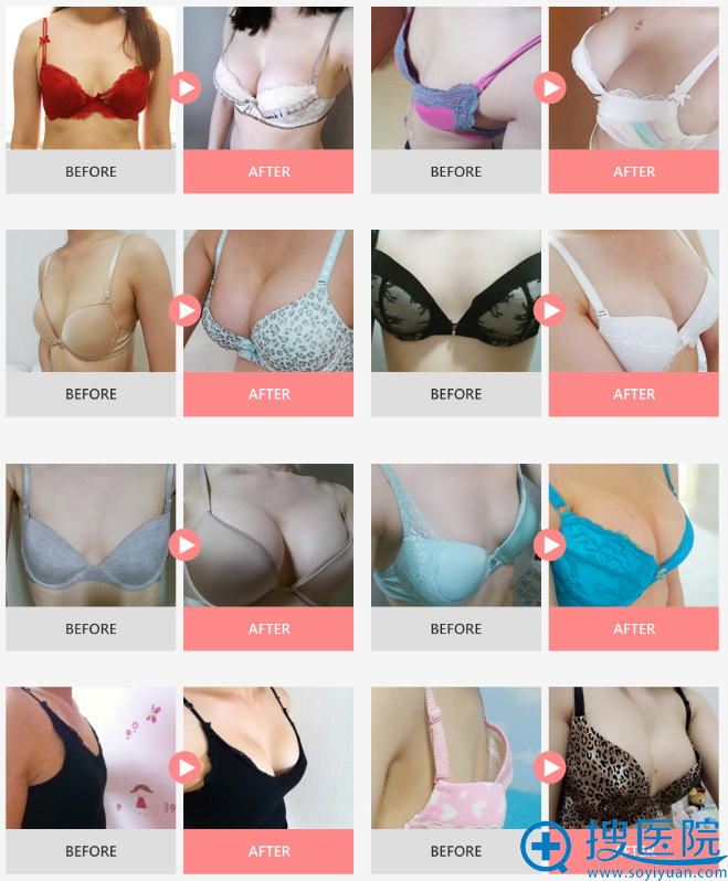 韩国麦恩整形外科医院隆胸术前术后对比案例 韩国麦恩整形外科医院隆胸术前术后对比案例