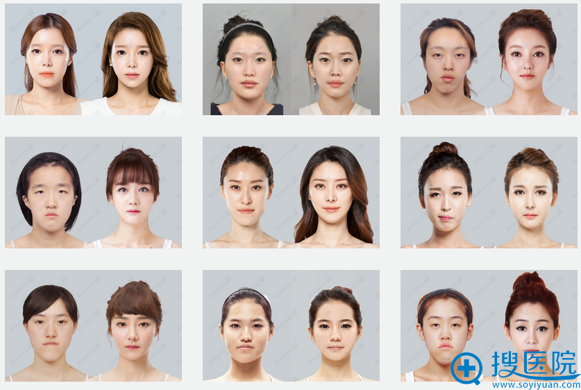 韩国ID整形医院双鄂手术前后对比案例 韩国ID整形医院双鄂手术前后对比案例