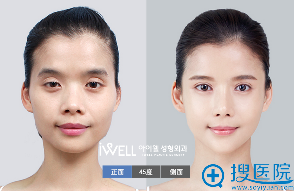 韩国爱我整形医院面部轮廓案例 韩国爱我整形医院面部轮廓案例