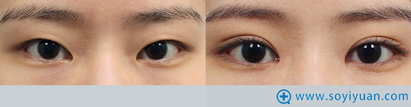 韩国爱我整形医院双眼皮案例 韩国爱我整形医院双眼皮案例
