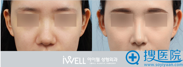 韩国爱我整形医院假体隆鼻案例 韩国爱我整形医院假体隆鼻案例