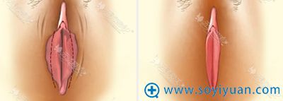 韩国好手艺妇科阴唇整形 韩国好手艺妇科阴唇整形
