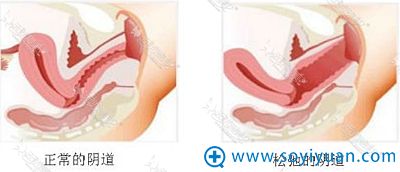 韩国好手艺妇科医院阴道紧缩术 韩国好手艺妇科医院阴道紧缩术