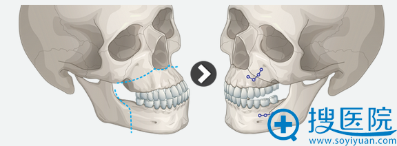 韩国ID整形医院双鄂手术方法 韩国ID整形医院双鄂手术方法