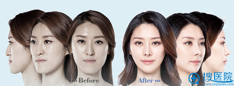 韩国ID整形医院双鄂整形前后对比案例 韩国ID整形医院双鄂整形前后对比案例