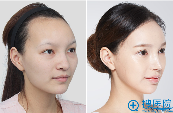 韩国DA整形外科医院面部轮廓整形案例 韩国DA整形外科医院面部轮廓整形案例