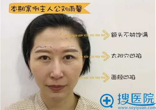 面部自体脂肪填充术前照片 面部自体脂肪填充术前照片