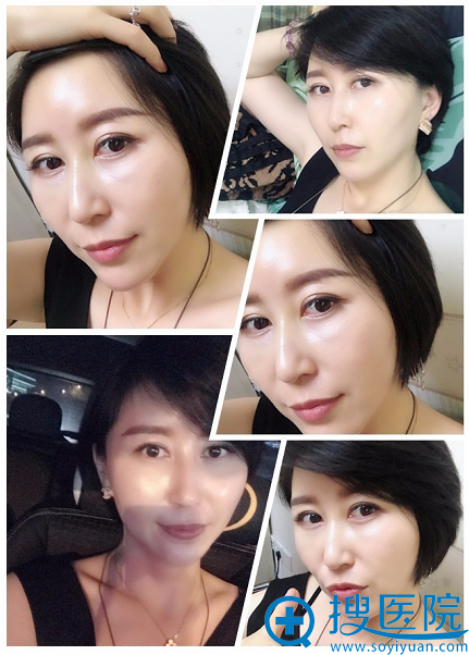 自体脂肪填充术后生活照 自体脂肪填充术后生活照