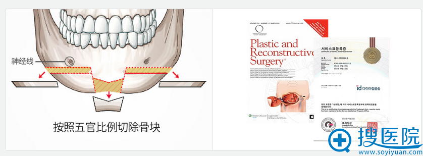 钻石截骨术+下颌角缩小手术方法 钻石截骨术+下颌角缩小手术方法