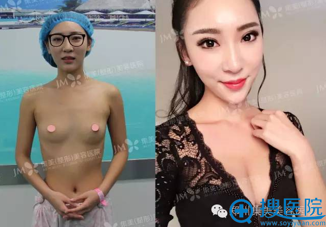 在郑州集美做假体隆胸前后对比图 在郑州集美做假体隆胸前后对比图