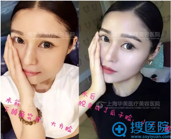 下颌角整形前后对比照照 下颌角整形前后对比照照