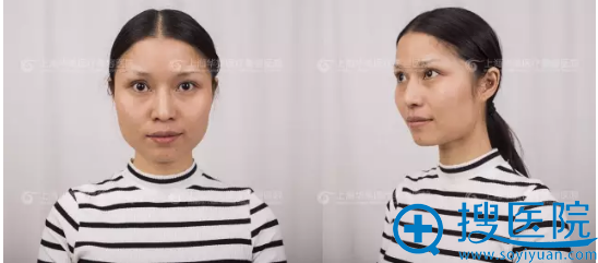 下颌角整形术前 下颌角整形术前