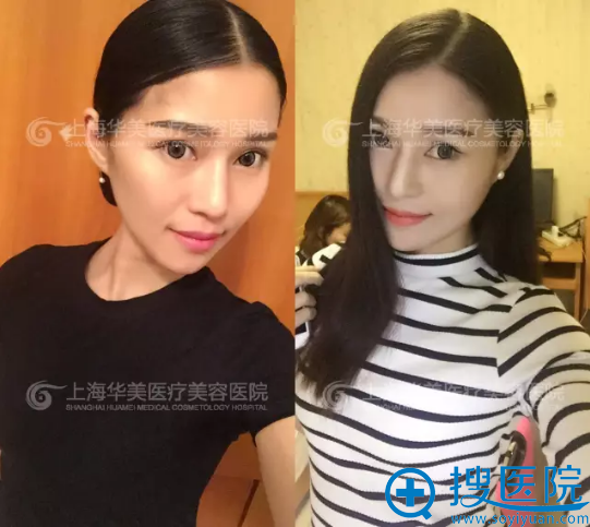 下颌角30天恢复期照片 下颌角30天恢复期照片