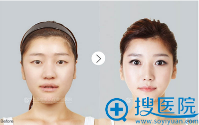 上海华美许再荣双眼皮案例 上海华美许再荣双眼皮案例