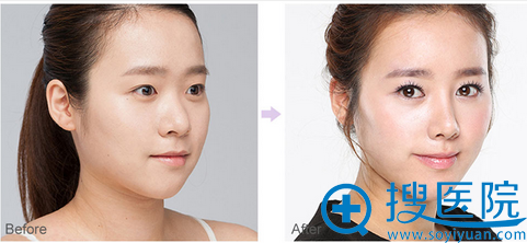 上海华美李庭勋鼻尖整形案例 上海华美李庭勋鼻尖整形案例