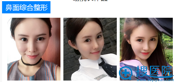 上海华美谢卫国鼻综合案例 上海华美谢卫国鼻综合案例