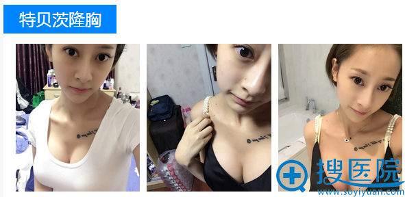 上海华美谢卫国特贝茨双平面隆胸案例 上海华美谢卫国特贝茨双平面隆胸案例